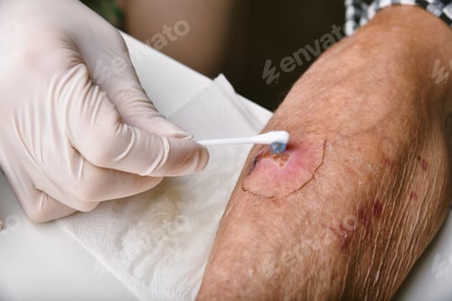 Vista previa: Wound dressing
