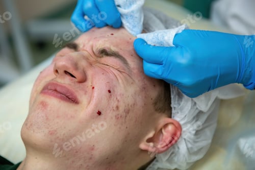 Preview: A young Caucasian teenage boy has a cosmetologist cleaning his face. A dermatologist treats acne on