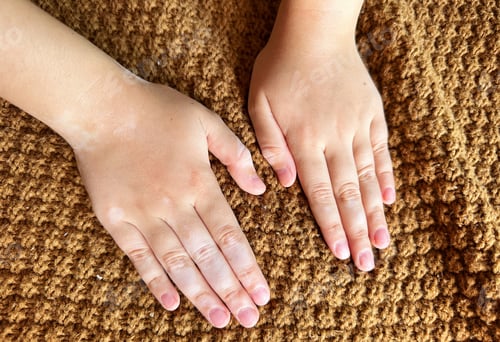 Preview: little caucasian girl suffering from vitiligo disorder. person with skin condition that causes loss