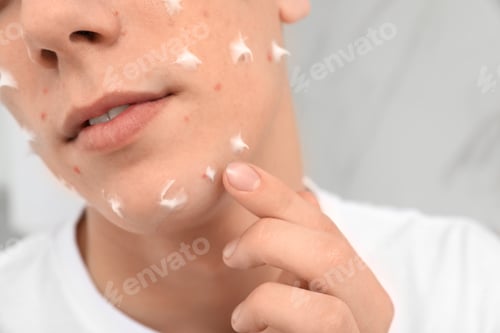 Preview: Teen guy with acne problem applying cream indoors, closeup