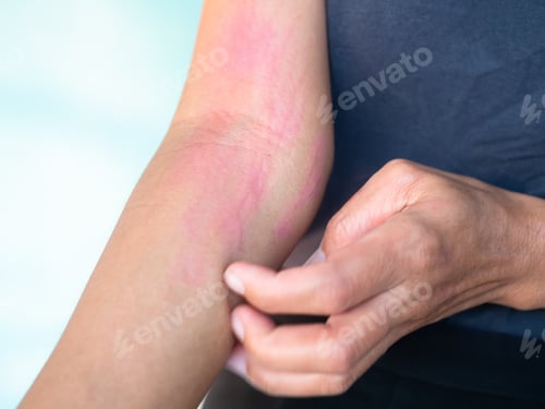 Preview: Hand with urticaria allergy itchy rash eczema