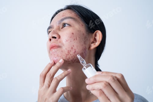 Preview: Acne on face because the disorders of sebaceous glands productions. Acne or a Cosmetic Allergy.