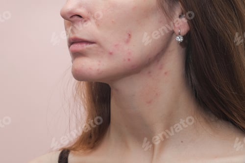 Preview: Woman With Problem Skin. Teen Acne On Young Skin. Tools For Removing Acne.