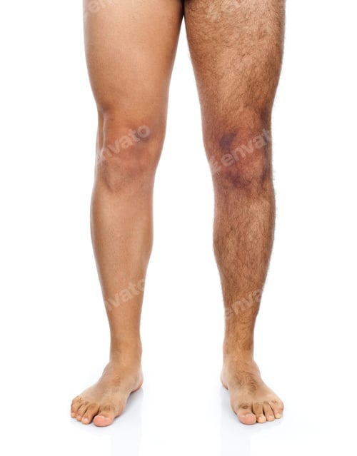Preview: Male hair removal on legs