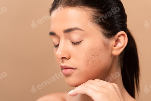 Preview: young woman with closed eyes and blemished skin isolated on beige