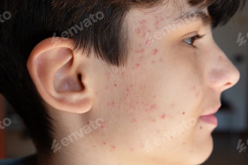Preview: Teen boy suffering from acne showing skin problems