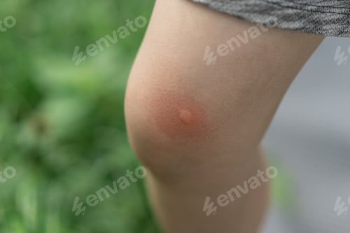 Preview: Mosquito bites on child legs. Outdoor recreation, against allergies. Protection from insect bites