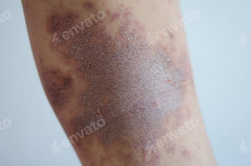 Preview: red rash girl Skin disease caused by allergies to drugs, food, chemicals,