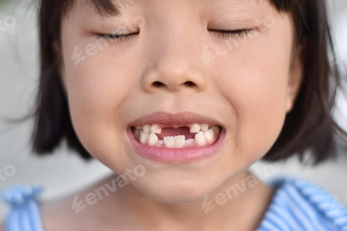 Preview: Cute little girl smile with her broken tooth. Close up of child front tooth broken.