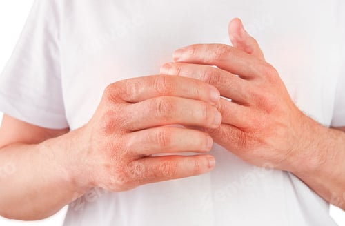 Preview: Man scratches or shows hands with dry, cracked skin on white backgrounds. Problem with many people -