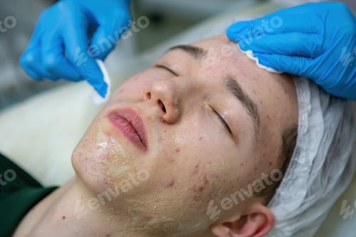 Preview: Acne treatment in a teenager.