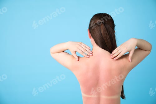 Preview: Woman with sunburned skin on light blue background, back view. Space for text