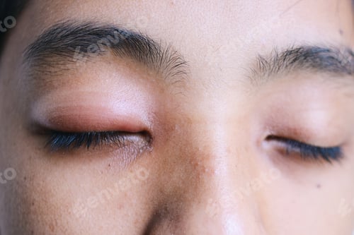 Preview: Eye Stye Infection