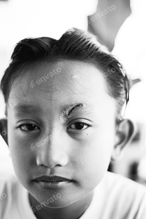 Preview: Healed minor cut wound after the surgical glue stitches. Scar at left eyebrow of Southeast Asian,