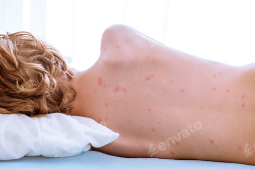 Preview: Anonymous boy with varicella disease on bed