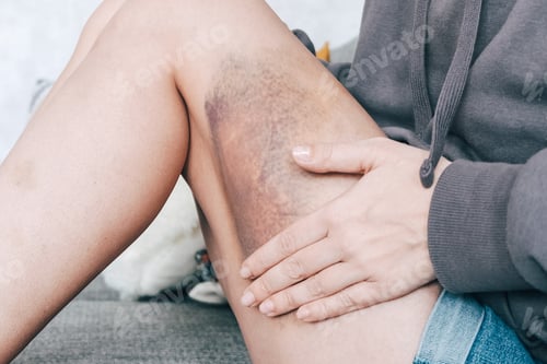Preview: Woman with Bruise on Leg Resting Hand on Thigh