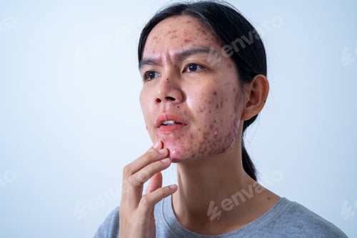 Preview: Acne on face because the disorders of sebaceous glands productions. Acne or a Cosmetic Allergy.