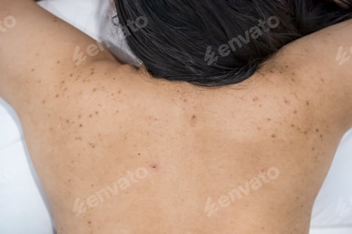 Preview: Acne on the back of the skin care woman is caused by bacteria.
