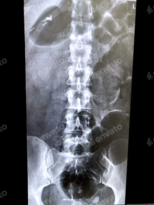 Preview: An x-ray of a spine backbone vertebrae from the front (supine) showing the deterioration of the L5S1