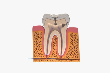 Preview: Section of a Tooth with Decay