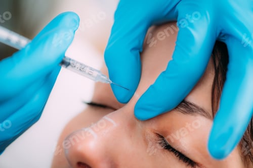 Preview: Dermal Filler for Nose Bridge Treatment.