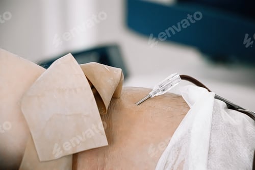 Preview: Catheter in vein close-up. International Blood Donation Day.