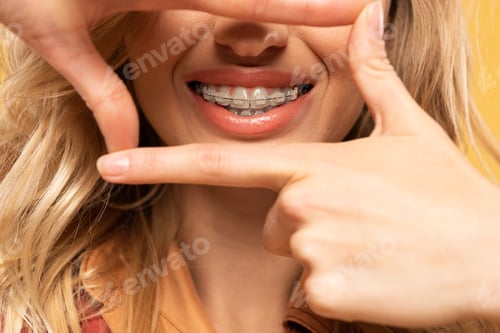 Preview: Cropped view of smiling woman with dental braces isolated on yellow