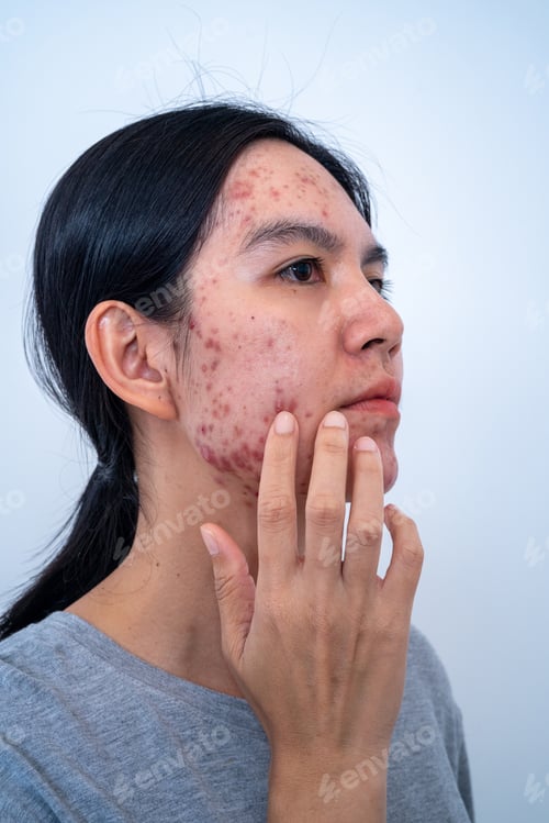 Preview: Acne on face because the disorders of sebaceous glands productions. Acne or a Cosmetic Allergy.