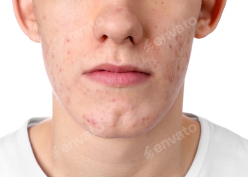 Preview: Young man with acne problem isolated on white, closeup