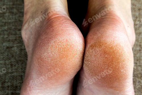 Preview: Dry cracked skin of woman feet in bed. Foot treatment.
