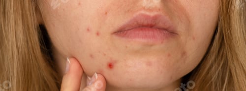 Preview: Unrecognizable woman showing her acne on face. Banner Close-up acne on woman's face with rash skin