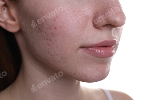 Preview: Young woman with acne problem on white background, closeup