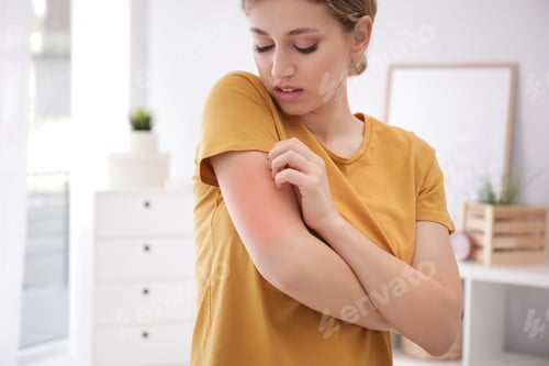 Preview: Woman scratching arm indoors, space for text. Allergy symptoms