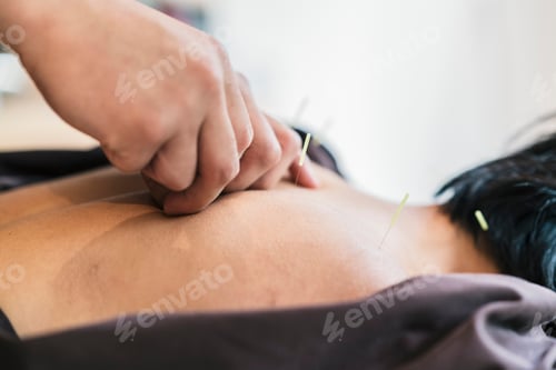 Preview: Therapist Giving Cupping Treatment To Young Asian Woman