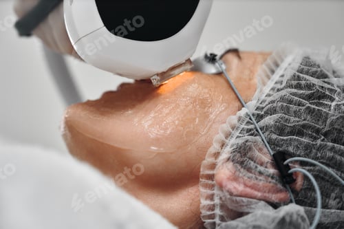 Preview: A woman receives IPL therapy in a beauty salon.
