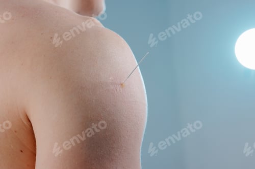 Visualização: Professional acupuncturist performing dry needling therapy on a patient's back for pain relief.