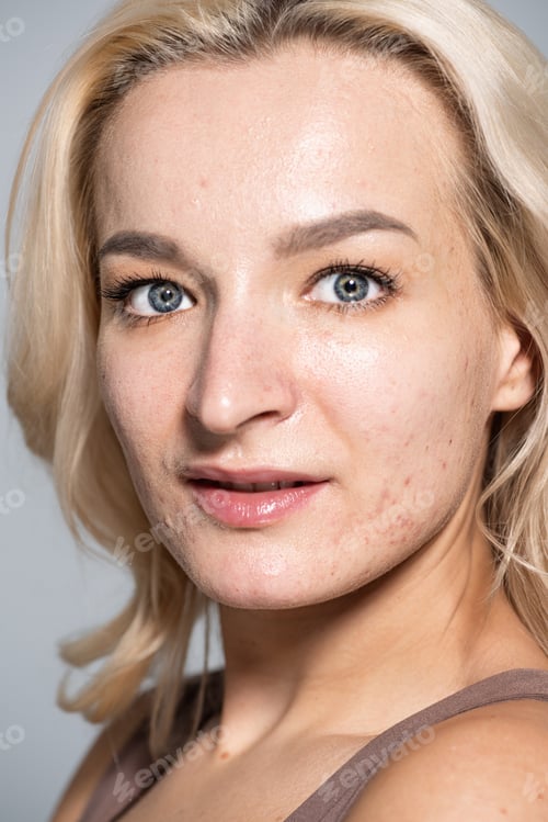 Preview: Close up view of woman with skin issue looking at camera isolated on grey