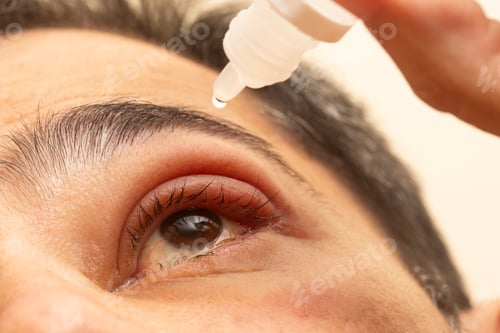 Preview: Hand placing drops of eye drops in inflamed eye with infected stye