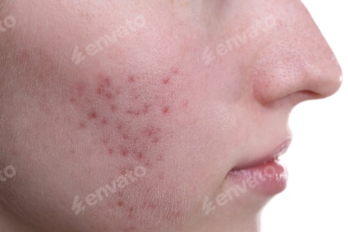 Preview: Young woman with acne problem on white background, closeup