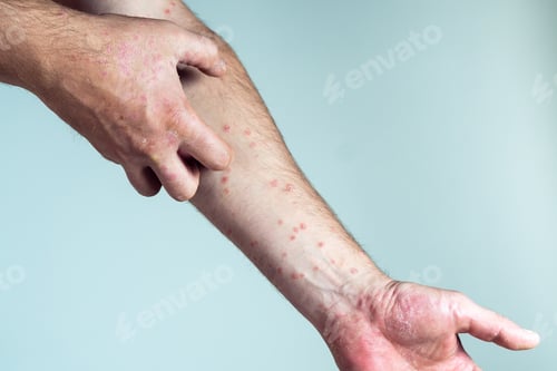 Preview: Unrecognizable man suffering from psoriasis scratching thick clusters, flaky rash on skin of arm wit