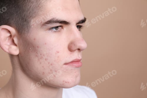 Preview: Young man with acne problem on beige background, closeup. Space for text