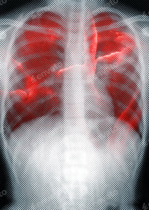 Preview: Respiratory tract infection shown on x-ray due to coronavirus