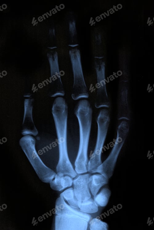Preview: X-ray hand