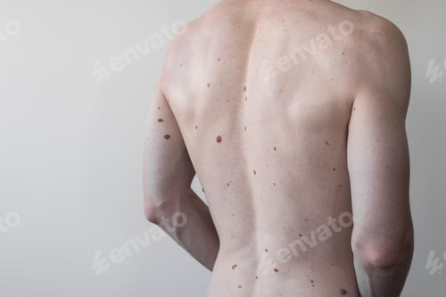 Preview: Male torso with a lot of moles,