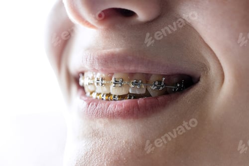 Preview: dental braces on teeth of teenager girl closeup