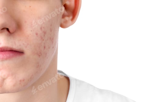 Preview: Young man with acne problem isolated on white, closeup
