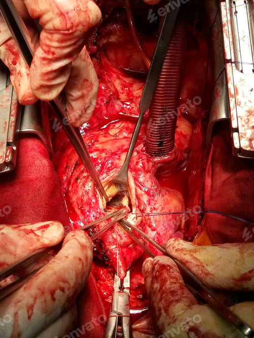 Preview: Surgeon hands are tying a knot during the open heart procedure chest during heart surgery