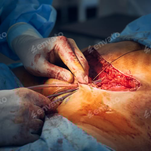 Preview: Close Up View of Surgical Procedure in Hospital