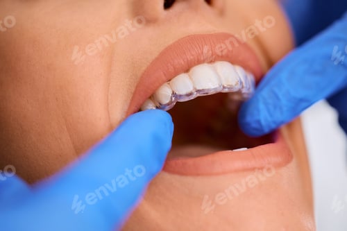 Preview: Close up of dentist applying invisible aligners on woman's teeth at dental clinic.