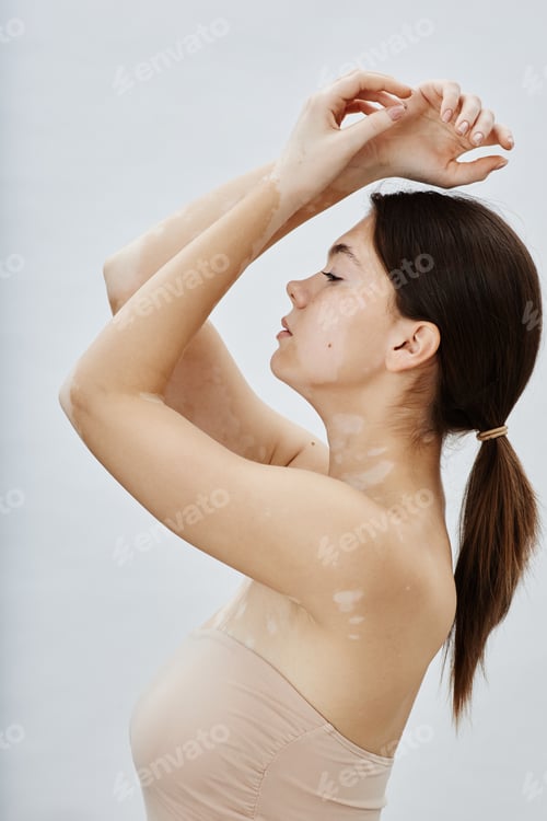Preview: Profile of Woman with Vitiligo Raising Arms in Feeling of Self Love in White Studio